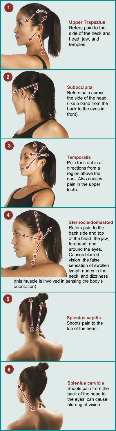 Six diagrams showing how myofascial trigger points contribute to fibromyalgia headaches.