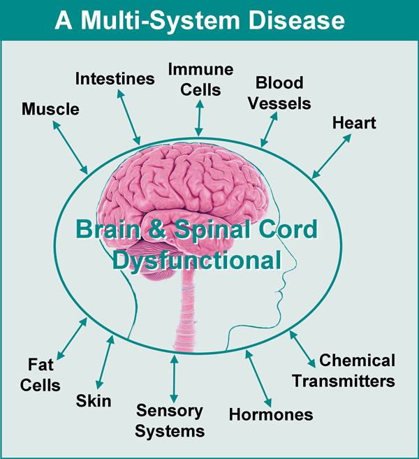 Illustration diagram showing what fibromyalgia is - a multi-system disease